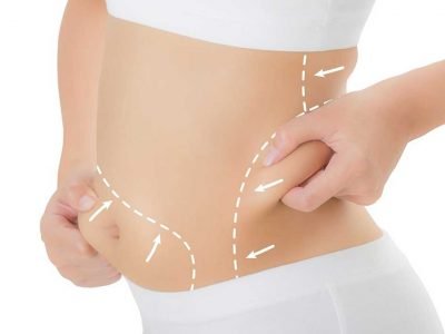 Non-Surgical Procedures For Fat Reduction