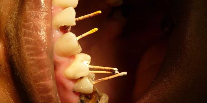 Five benefits of root canal treatment