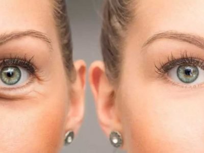 Wrinkles-Between-Eyebrows