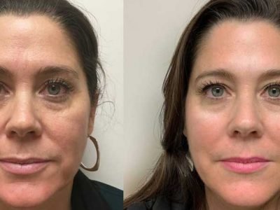 Cosmetic Facial Acupuncture Reduce Wrinkles