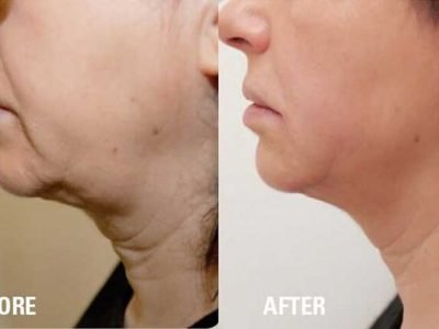 HIFU Treatment Results