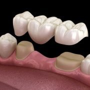 Is A Dental Bridge Permanent
