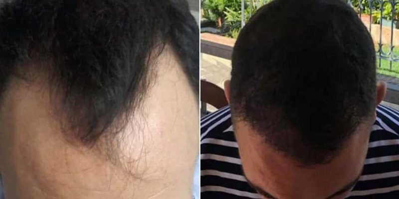 Hair-Transplant-Before-and-After-a-Comprehensive-Guide