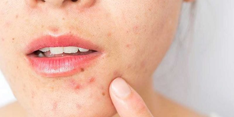 What-is-the-main-cause-of-acne