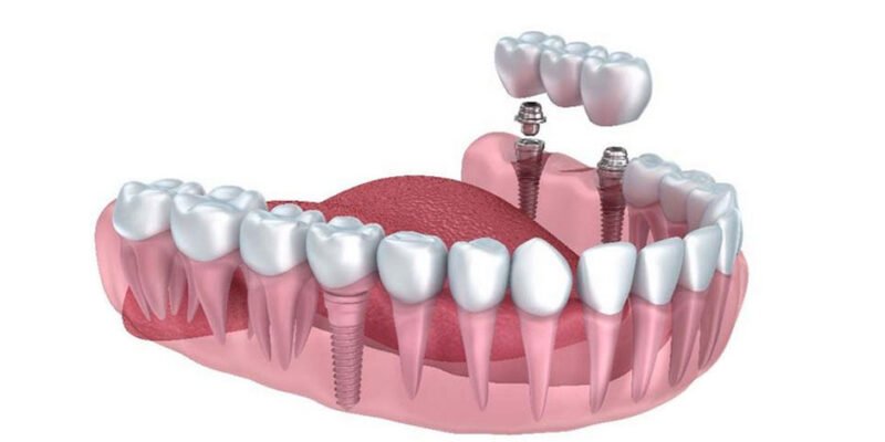 Unveiling the Art and Science of Dental Implants in San Antonio