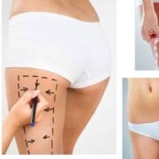 Advances in Thigh Lift Surgery in Turkish Cosmetic Centres