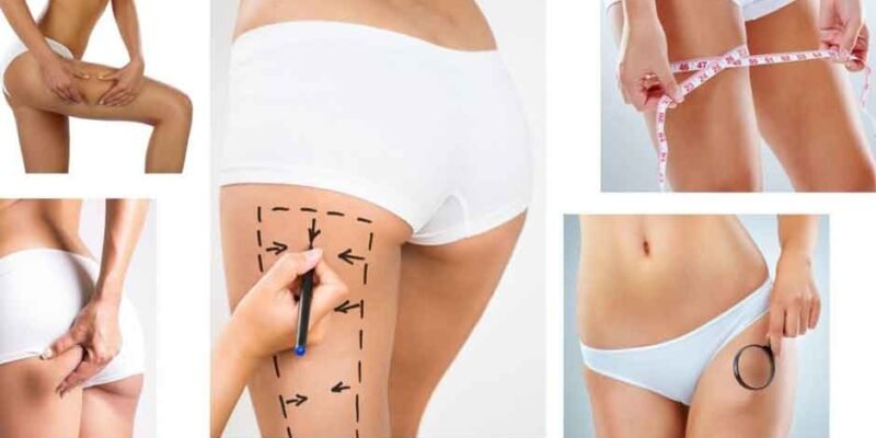 Advances in Thigh Lift Surgery in Turkish Cosmetic Centres