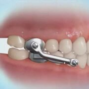 The Different Types of Orthodontic Appliances and Their Uses
