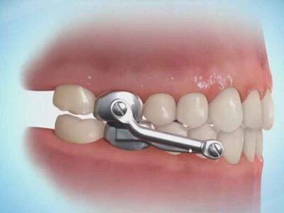The Different Types of Orthodontic Appliances and Their Uses