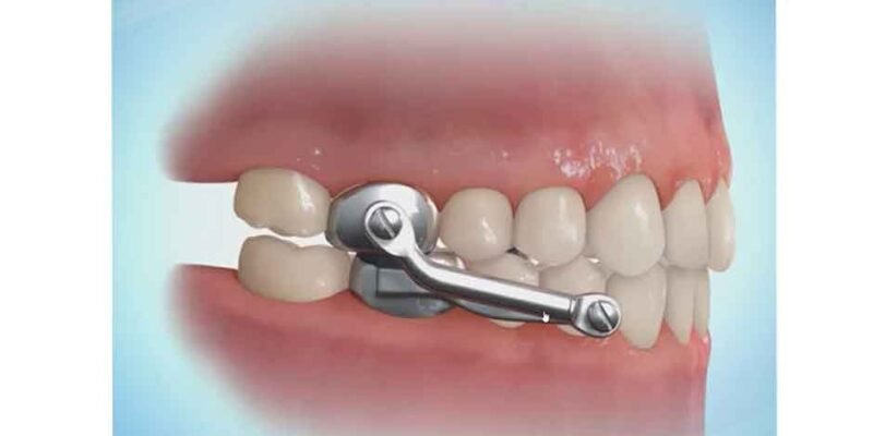 The Different Types of Orthodontic Appliances and Their Uses
